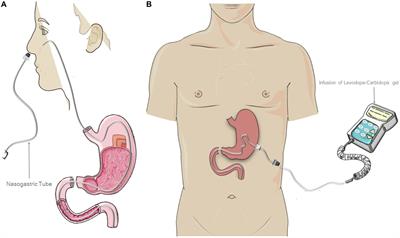 Gender disparity in access to advanced therapies for patients with Parkinson’s disease: a retrospective real-word study